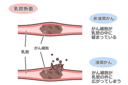 しこりを作らない乳がん（非浸潤性乳管がんなど）